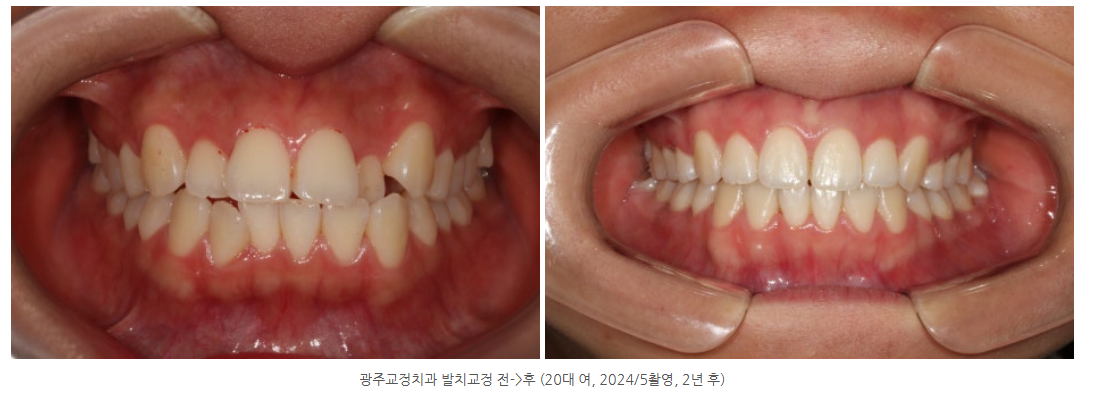 광산구에서 치아 발치를 통한 발치 치아교정을 잘하는 곳은?