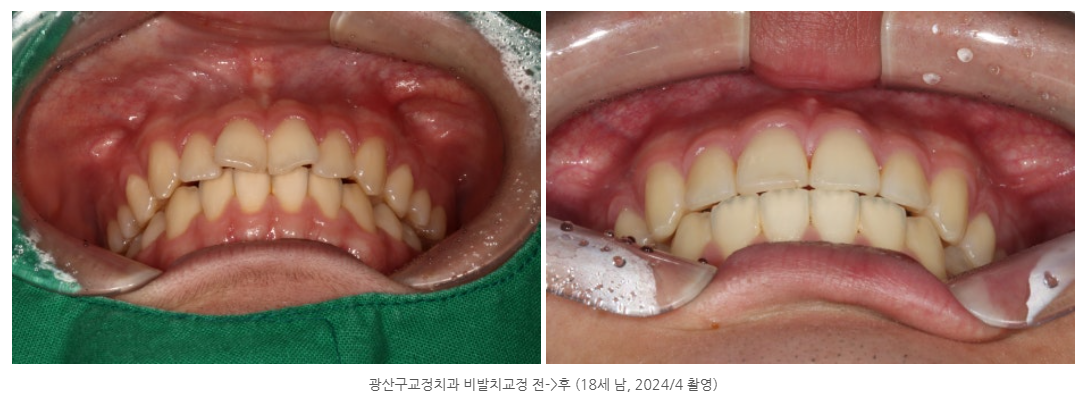광주에서 10대 청소년 치아교정을 하기 전에 꼭 확인해야 할 것은?