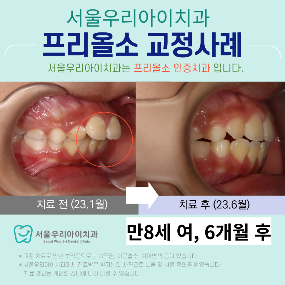 프리올소 입술을 빨고 아래턱도 작은 만8세 여아 프리올소 교정사례