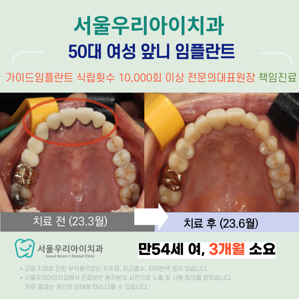 수완지구 앞니 임플란트 치과에서 앞니에 염증이 생겼을 때 어떻게...
