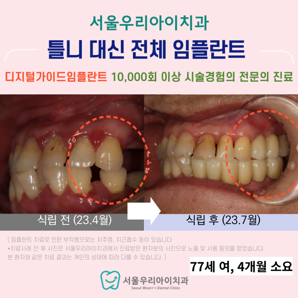 광주에서 70살이 넘어도 임플란트를 심을 수 있는 치과 있나요?