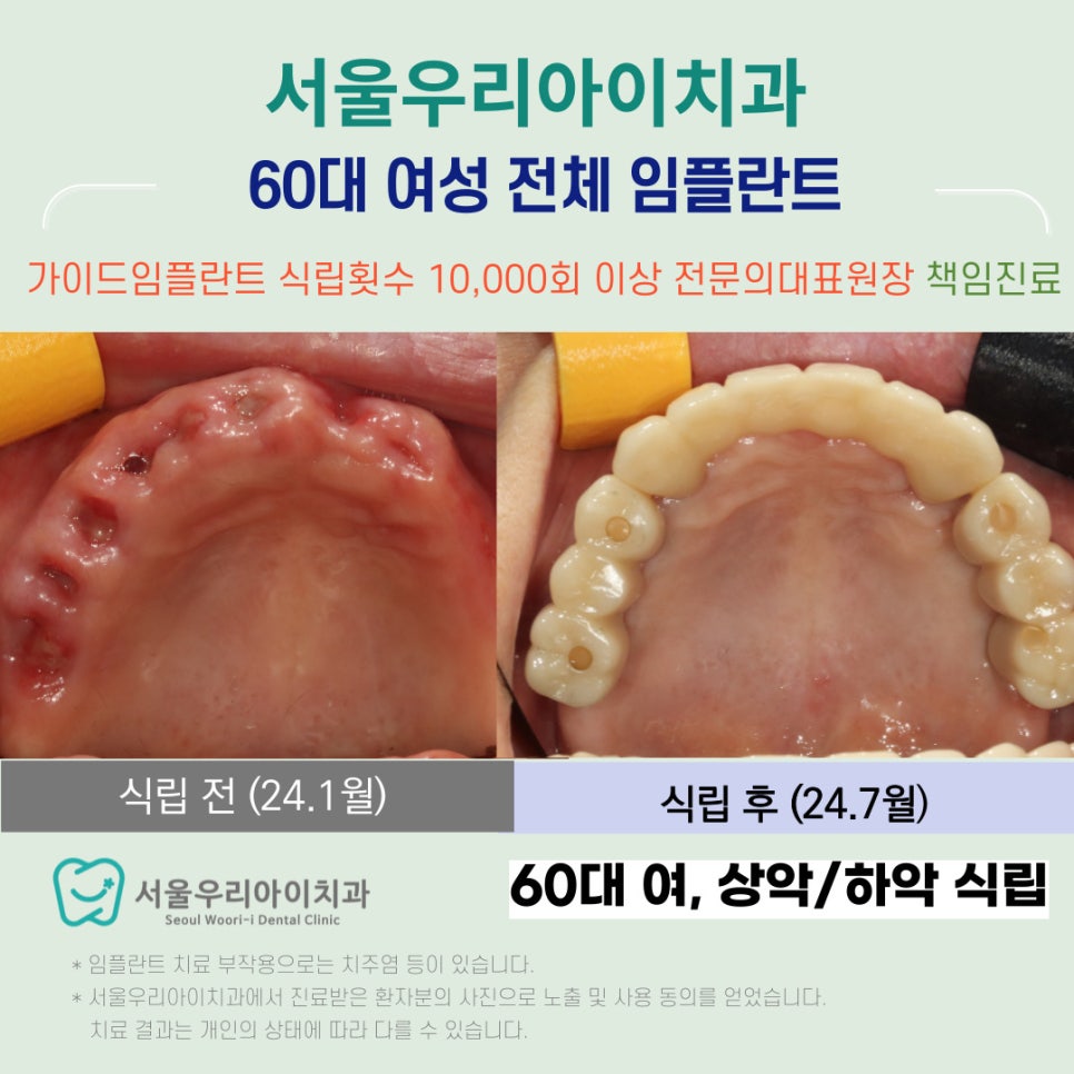 광산구 임플란트 치과에서 60대 여성 임플란트를 성공하는 방법?