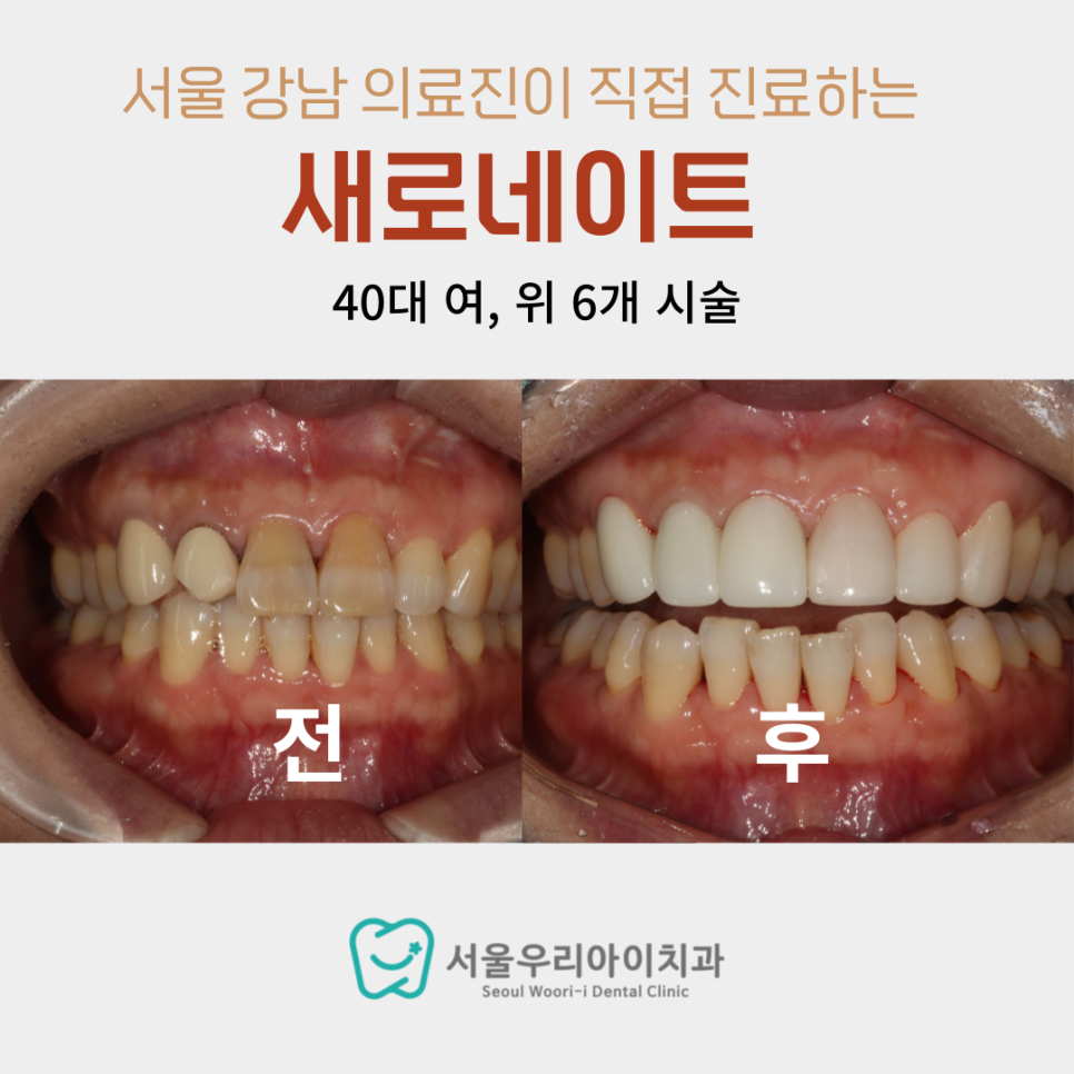 앞니 라미네이트 광주에서 잘하는 곳을 찾는다면 후회없을겁니다