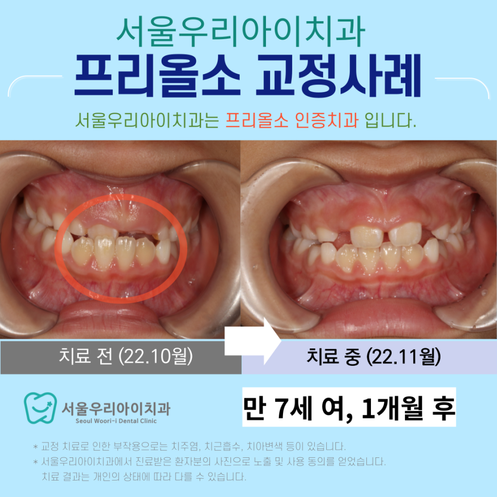광주 아이 반대교합 프리올소로 해결 가능할까요?