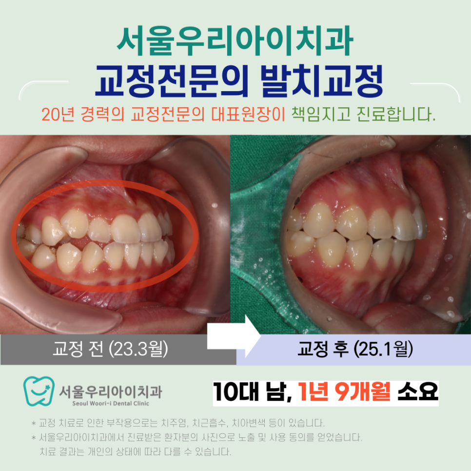 광산구 교정치과에서 20년 이상 경험많은 교정전문의 진료를 받아보세요