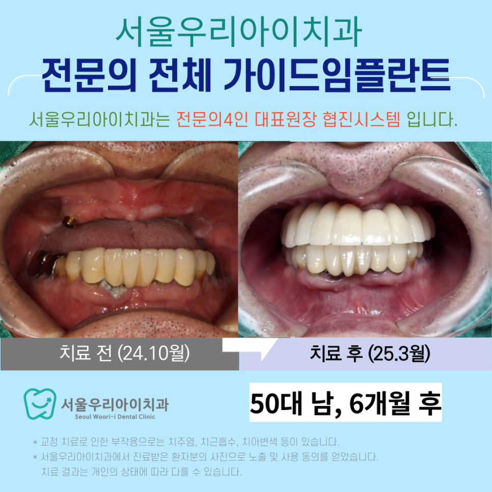 광주 전체 임플란트 전문의의 가이드임플란트 수술로 편하게 받으세요