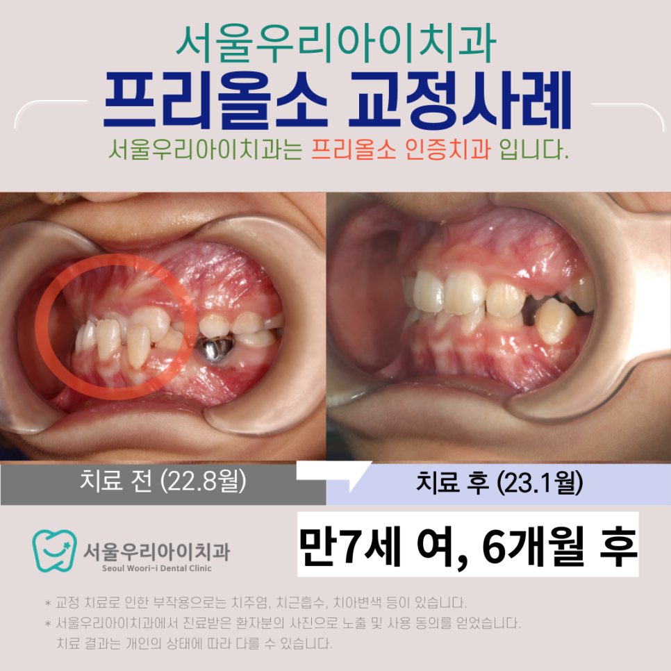 광주 아이교정치과 반대교합 교정은 어떻게 진행할까요?