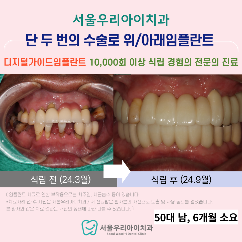 임플란트가 무섭고 두려운 광주 50대라면 읽어보세요