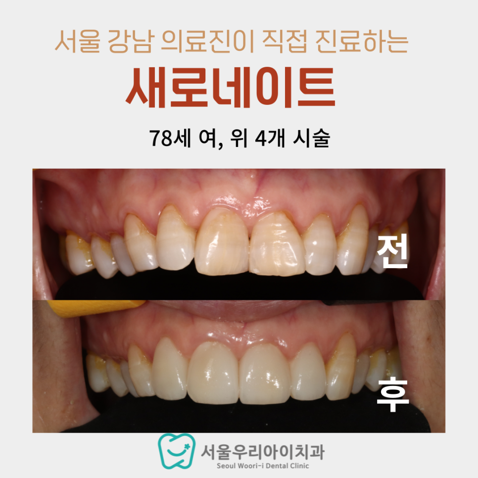 라미네이트는 몇 살에 할 수 있을까요? 78세 최고령 사례