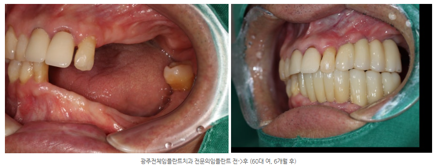 전체 임플란트를 할 때 몇 번이나 수술을 받아야 할까요? 단 두...
