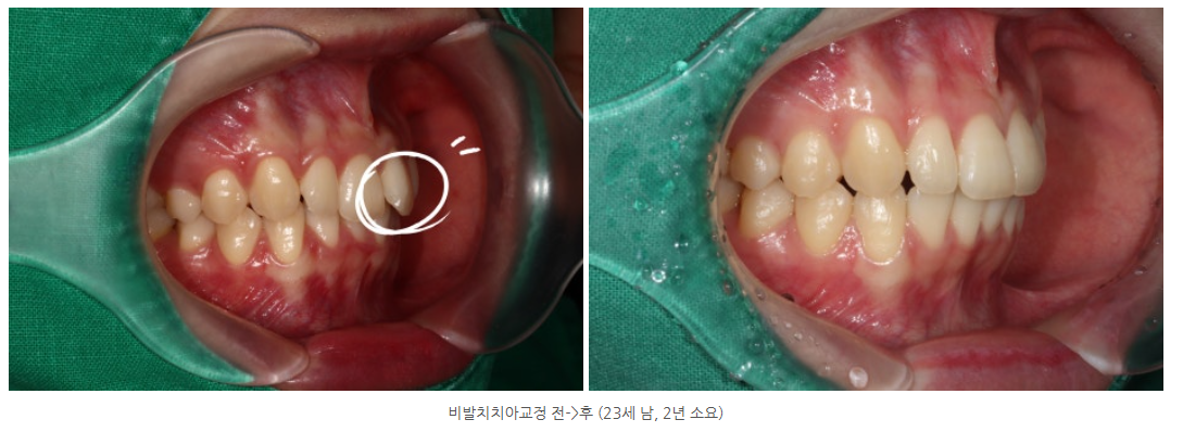 수완지구 교정치과 튀어나온 앞니 교정하는 방법은 무엇일까요?