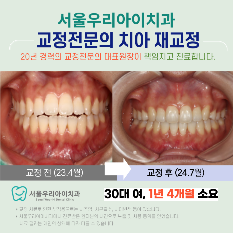 광주치아교정 치아재교정 20년 경험많은 교정전문의가 책임지고 완...