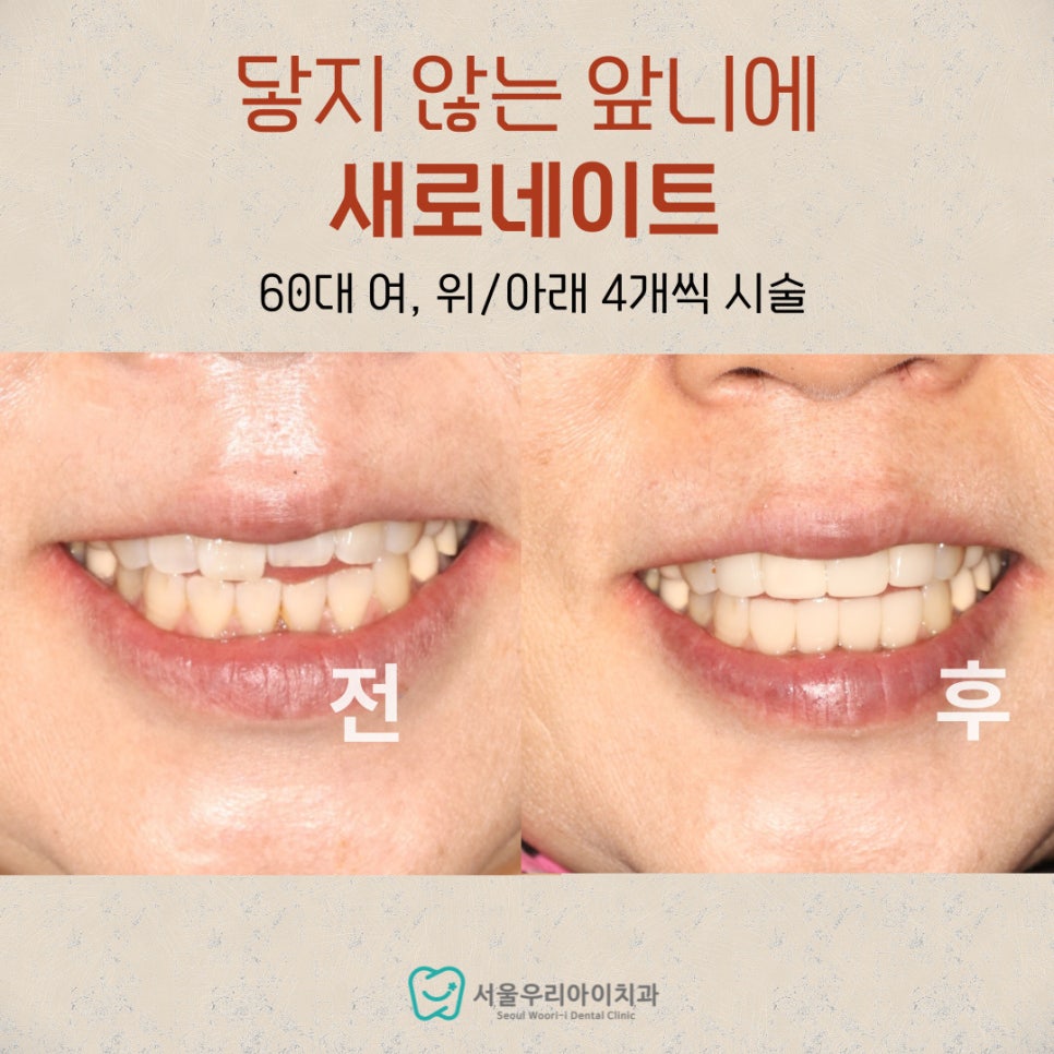 윗니와 아랫니가 서로 닿지 않아요. 해결 방법이 있나요?