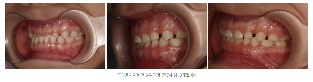 아이부정교합을 해결하는 프리올소 교정장치 효과는?
