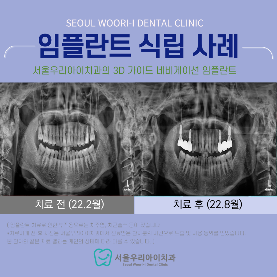 광주에서 고혈압 있어도 임플란트 수술이 가능한 치과를 찾는다면?