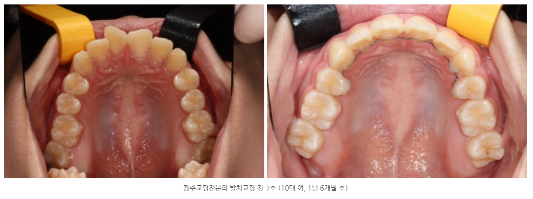 광주에서 돌출입 교정을 잘하는 교정치과를 찾는다면?