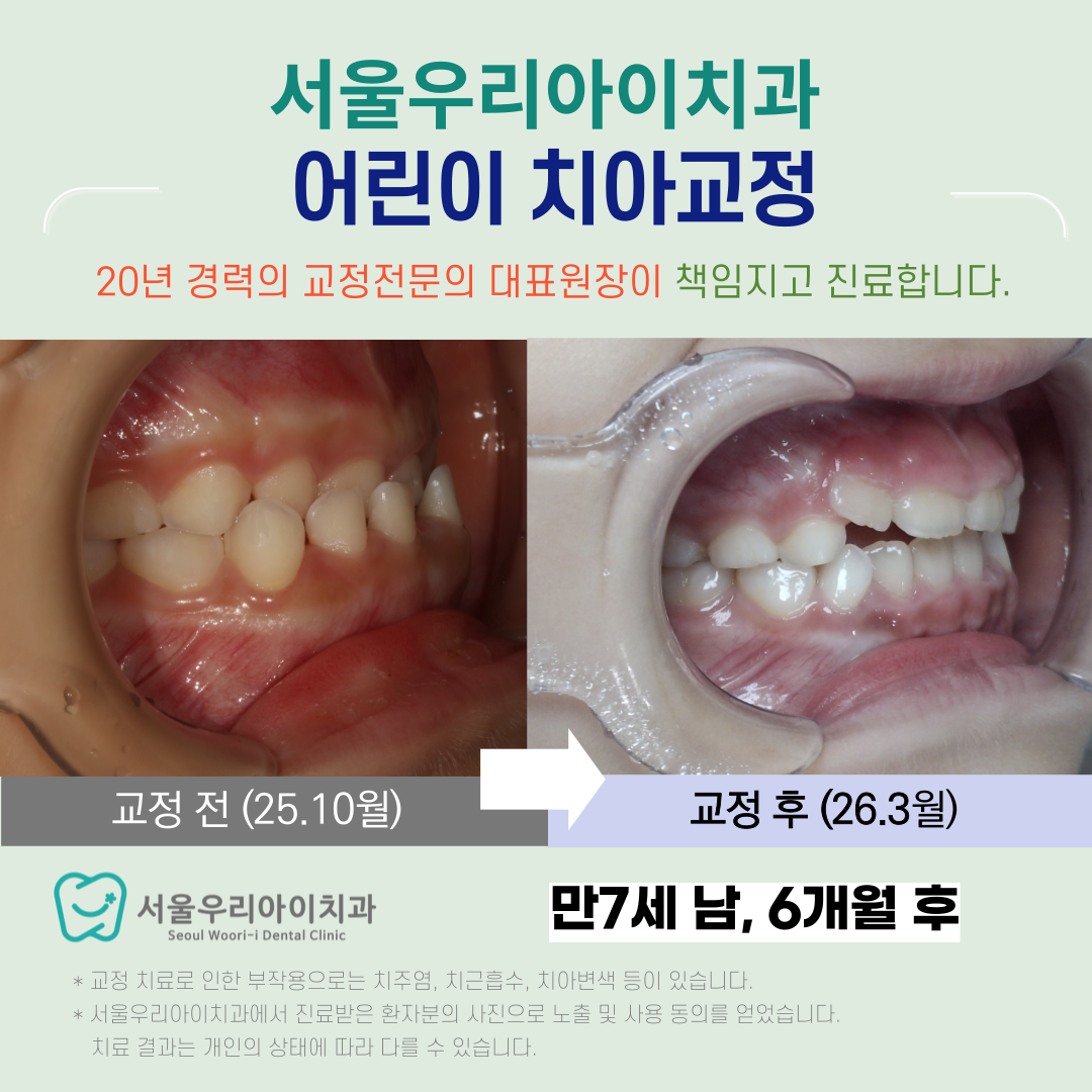 광주 어린이교정치과에서 반대교합을 해소하는 전문의 치아교정으로