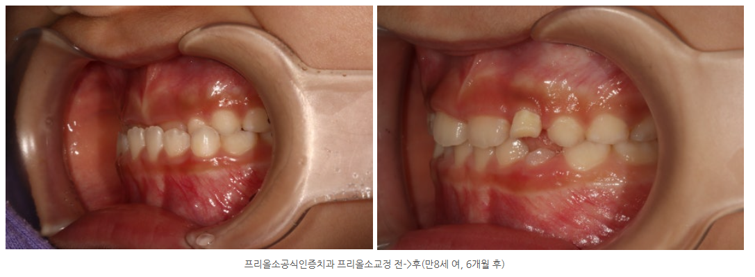 프리올소후기가 궁금한 광주학부모님들 계신가요?