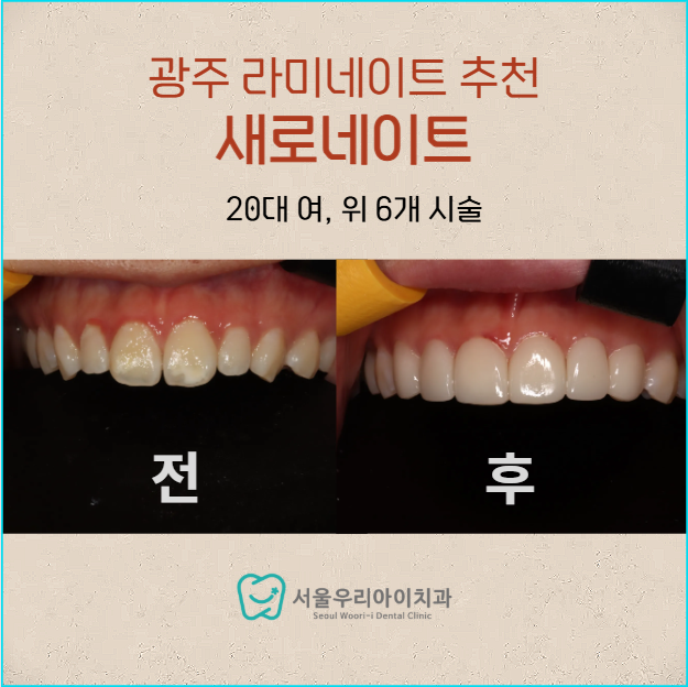 광주앞니라미네이트 얼룩덜룩한 앞니가 고민이라면