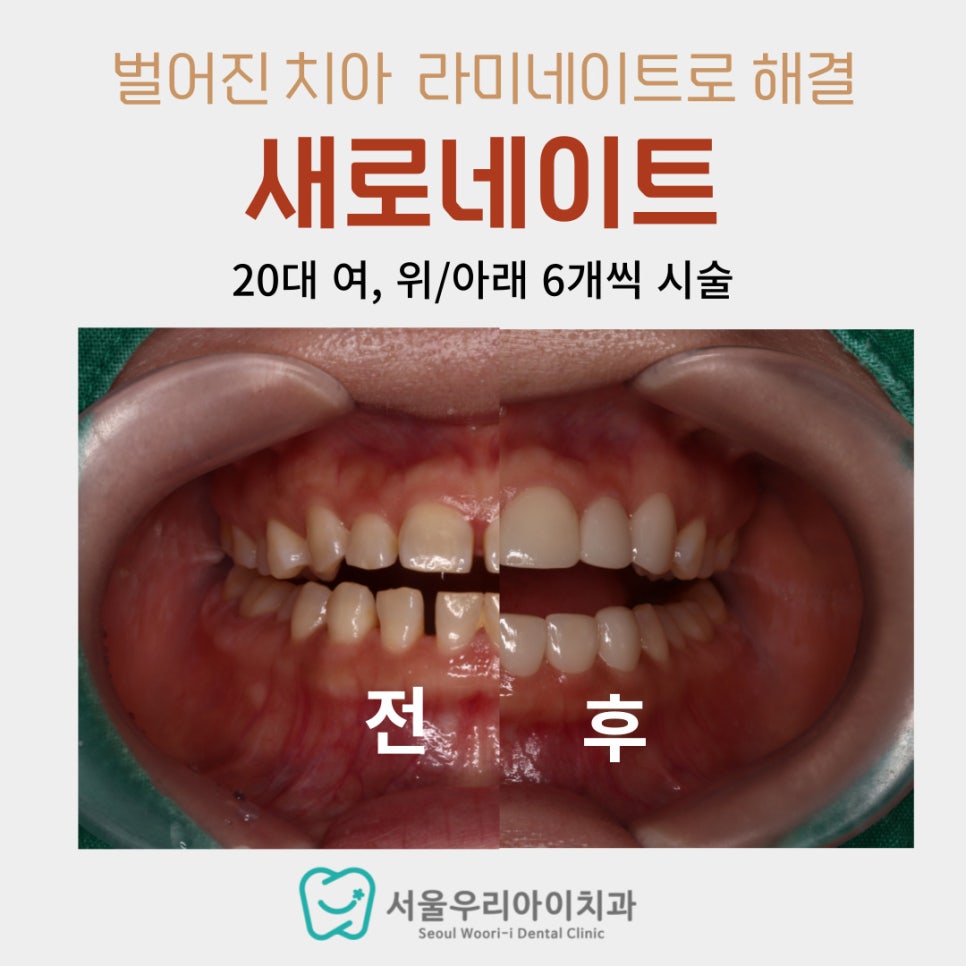 치아 사이 틈이 벌어졌어요. 치아 사이 틈으로 음식물이 끼어요....