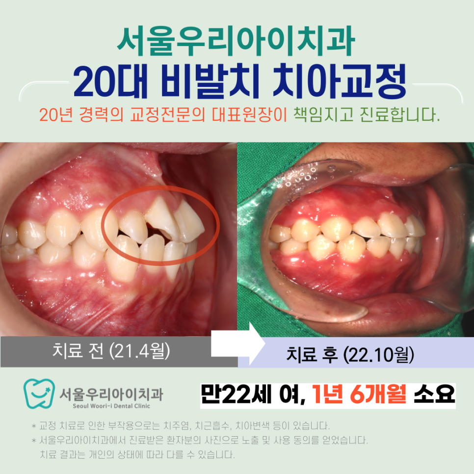 광주 교정전문의 발치하지 않고 비발치로 완성하는 사례