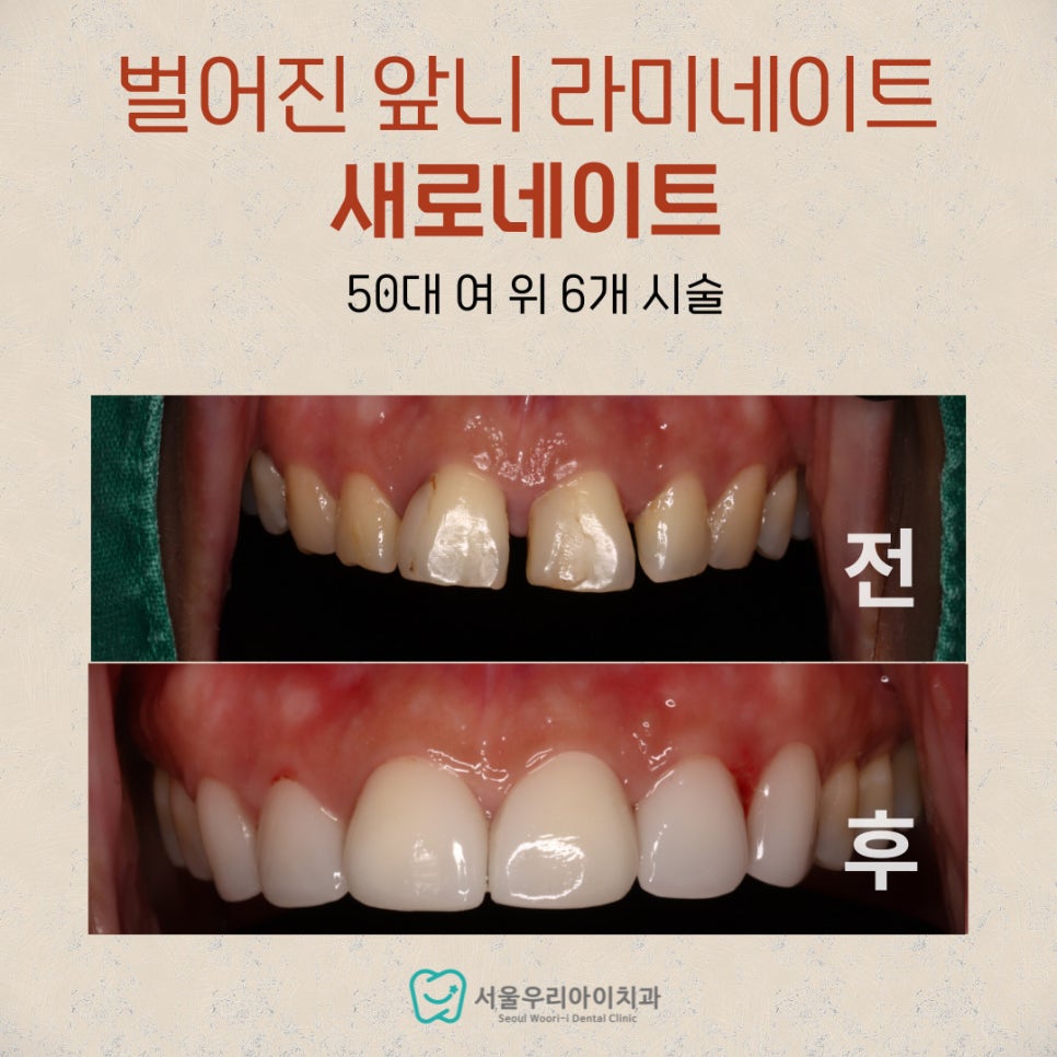 광산구 라미네이트 치과에서 벌어진 앞니를 개선하는 방법은?