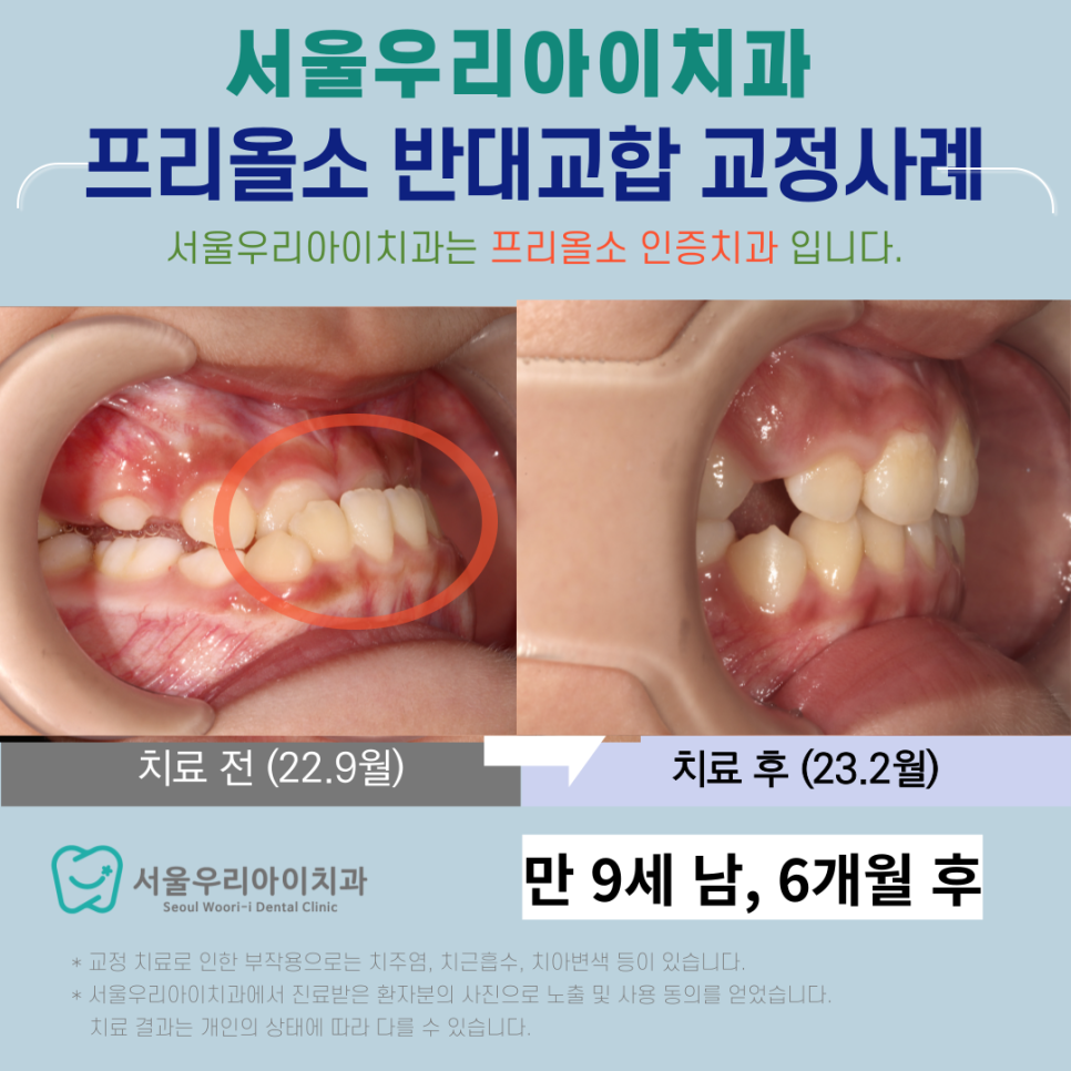 프리올소 광주에서 공식인증 치과를 찾는다면 여기입니다.